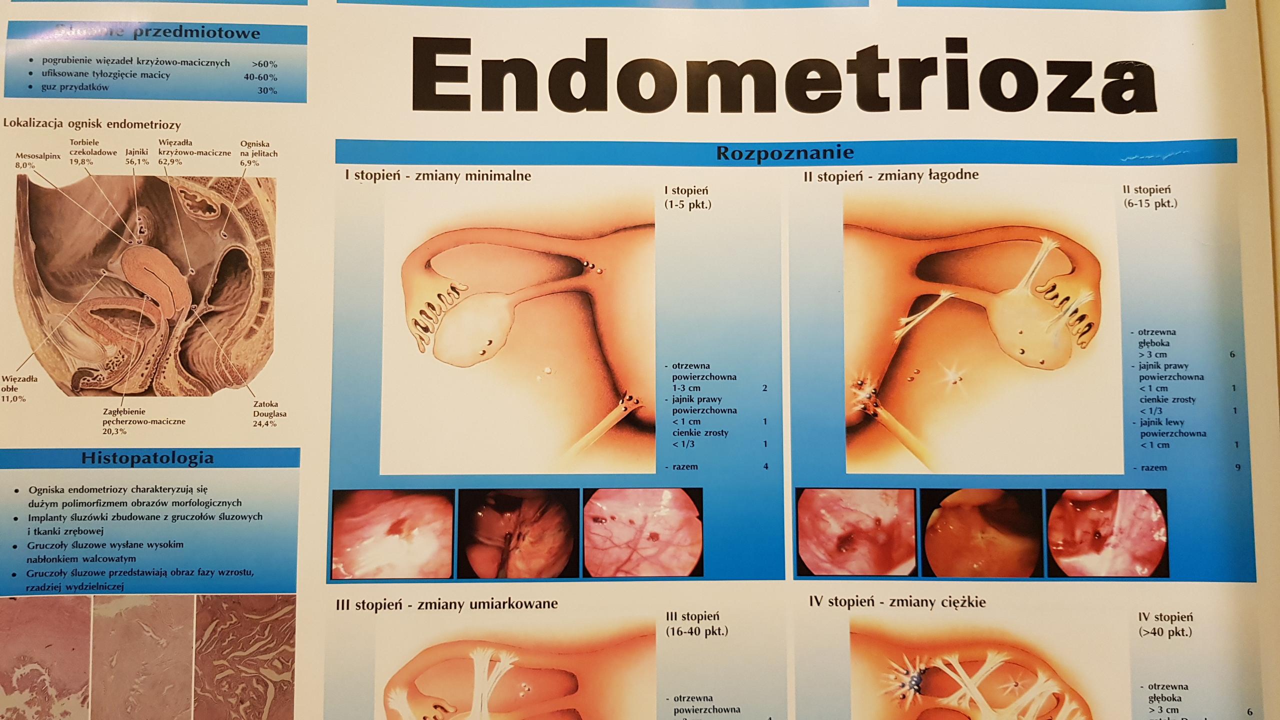 endometrioza